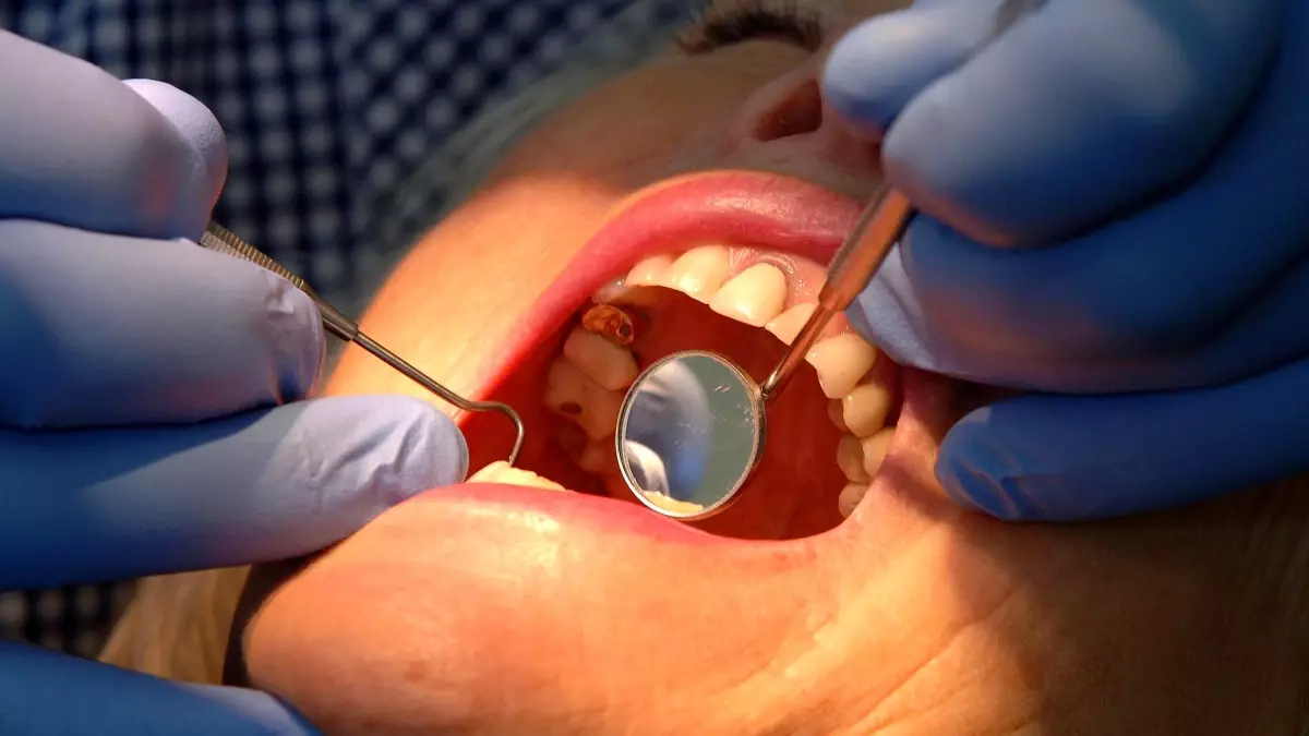 nottingham universitesinden dis minesini onaran yeni jel hJGESeLK.jpg